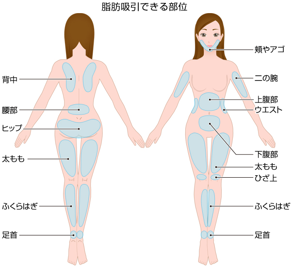 脂肪吸引できる部位