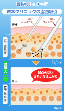 脂肪吸引用カニューレについて