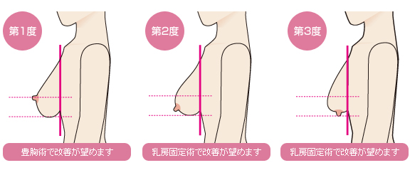 乳房下垂