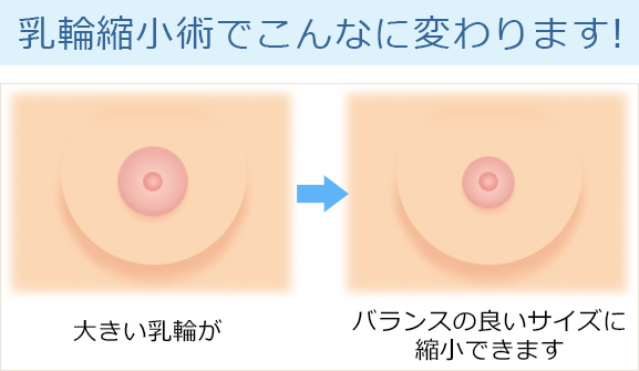 乳輪縮小術の手術方法