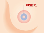 乳輪縮小術の手術方法