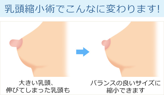 乳頭縮小術の手術方法