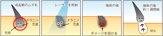 レーザー脱毛の仕組み