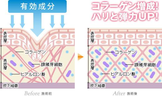 ダーマローラーを使用する事で真皮に起こる反応