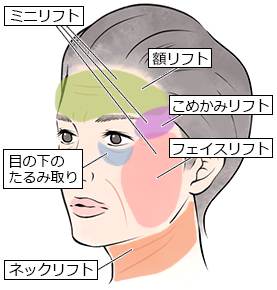 フェイスリフトの適用部位