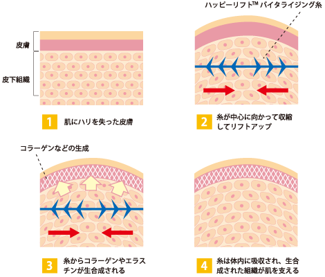 バイタライジング糸