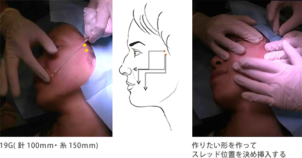 施術方法