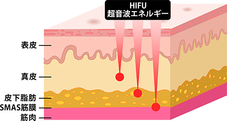 HIFUでたるみが改善する仕組み