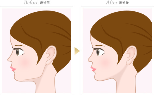 施術前:大きく張り出したエラ骨は、相手に男性的な印象を与えてしまいます。施術後:理想通りの小顔を実現し、女性的なやさしい印象を実現する事が可能