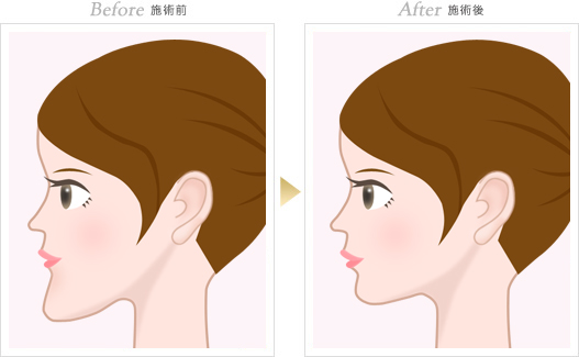 施術前:長いアゴは相手に「口が尖った顔」という印象を与えてしまいます。施術後:すっきりしたアゴは、女性らしい印象を与えます。