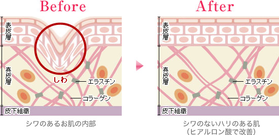 Before（シワがあるお肌の内部）→After（シワのないハリのある肌【ヒアルロン酸で改善】）