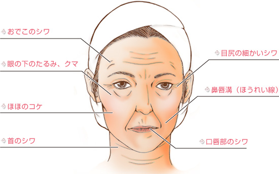 ヒアルロン酸の効果的な注入箇所