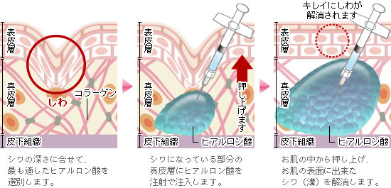 step1. シワの深さに合わせて、適したヒアルロン酸を選別します。step2. シワになっている部分の真皮層にヒアルロン酸を注射で注入します。step3. お肌の中から押し上げ、お肌の表面に出来たシワ（溝）を解消します。