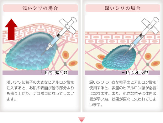 シワの深さとヒアルロン酸の粒子の大きさとの関係。浅いシワの場合、浅いシワに粒子の大きなヒアルロン酸を注入すると、お肌の表面が他の部分よりも盛り上がり、デコボコになってしまいます。深いシワの場合、深いシワに小さな粒子のヒアルロン酸を使用すると、多量のヒアルロン酸が必要になります。また、小さな粒子は体内吸収が早い為、効果が直ぐに失われてしまいます。