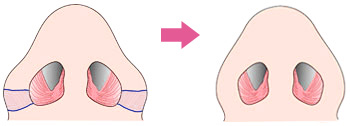 外側切開（余分な小鼻の皮膚を取り除く）