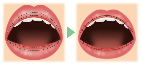 口唇縮小術の手術方法