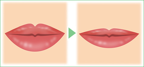 口唇縮小術ビフォーアフター