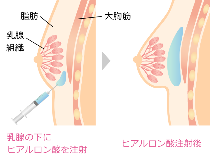 ヒアルロン酸注射時の説明図