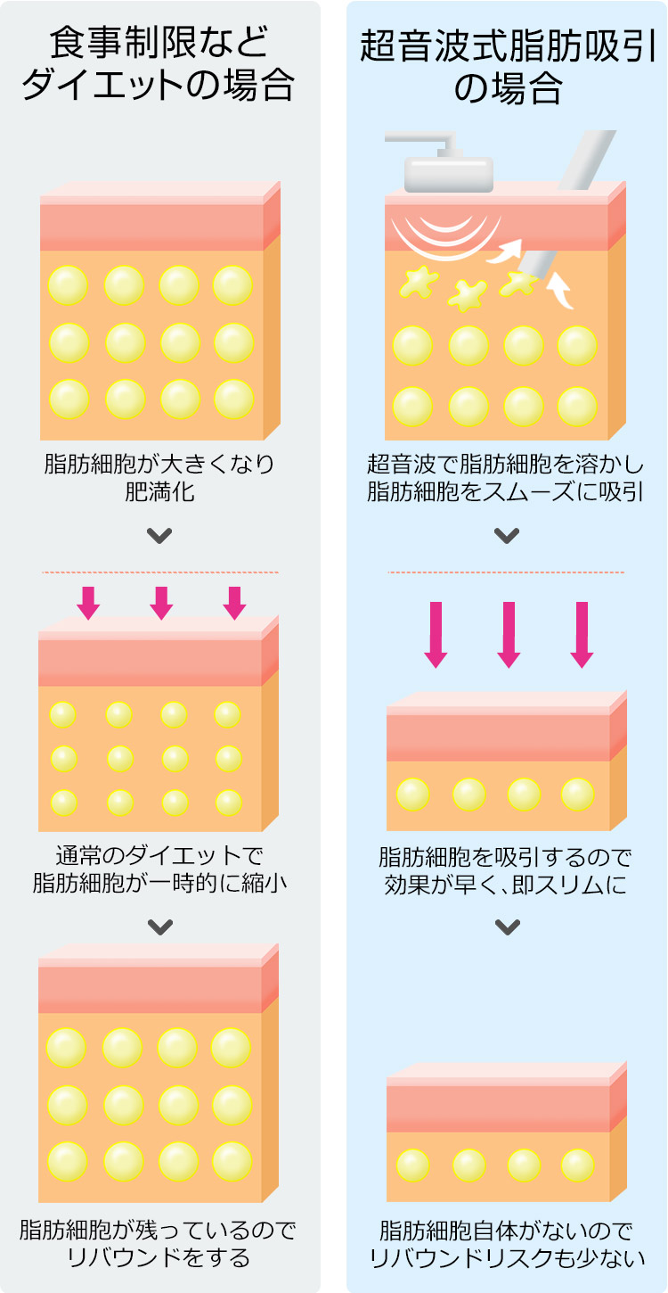 脂肪吸引用カニューレについて